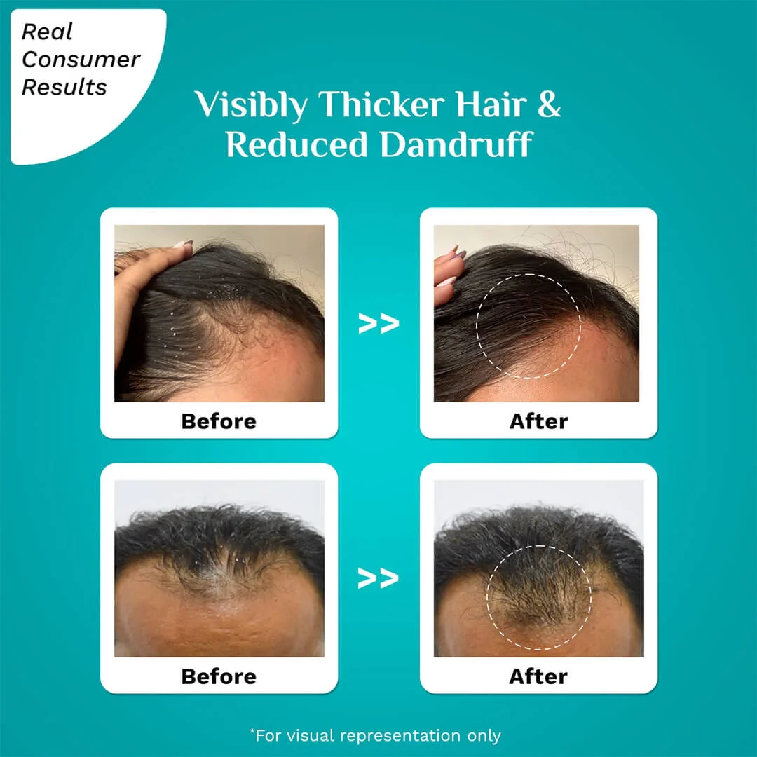 3% Redensyl & 4% Anagain Advanced Hair Growth Serum For Dandruff-Prone Scalp - 30 ml - Image 5