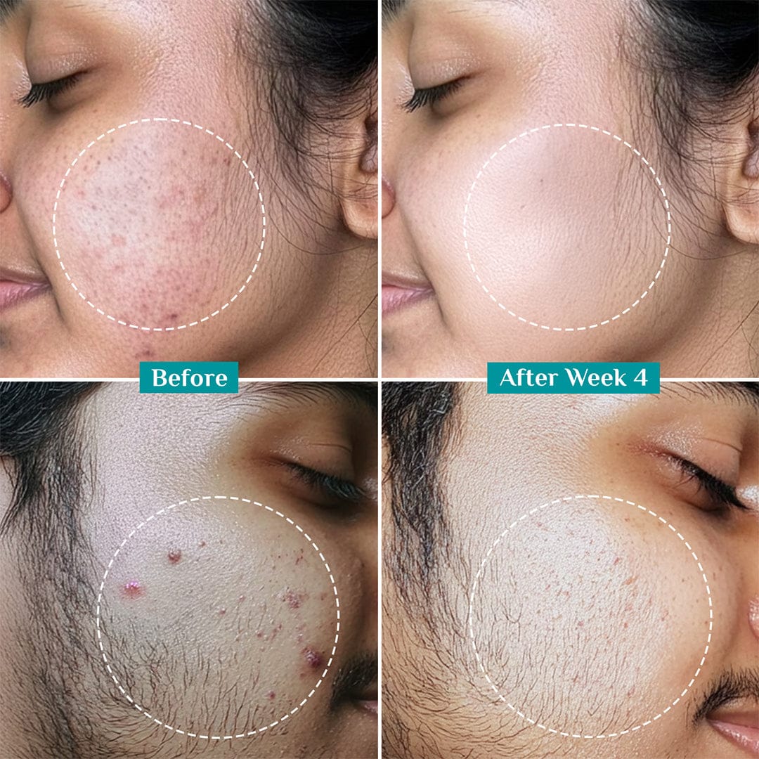 2% Salicylic Acid Anti-Acne Face Serum - Image 6